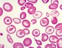 Thalassemia