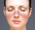 Lupus: a short summary