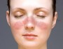 Lupus: a short summary