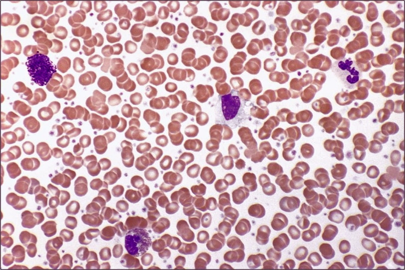 Polycythemia vera