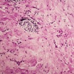 Reidel thyroiditis