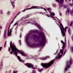 Psammoma body in papillary thyroid carcinoma