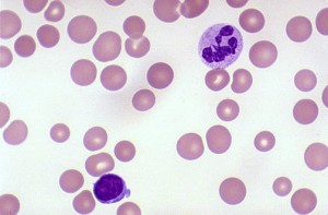 Megaloblastic anemia with hypersegmented neutrophil