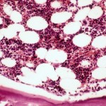 normal marrow