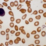 chronic myelofibrosis