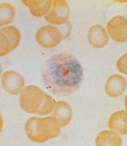 lap +1 lap 11 262x300 Leukocyte alkaline phosphatase