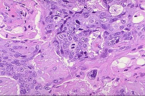 poorly differentiated squamous cell carcinoma
