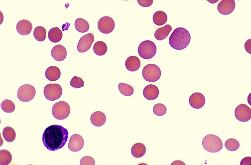 The immune hemolytic anemias