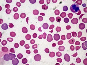 What are some symptoms of hemolytic anemia?