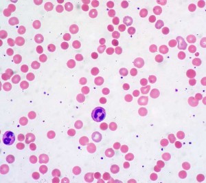 spherocytes spherocytes