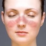 Lupus facial rash