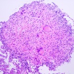 Granuloma