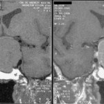 pituitary_adenoma