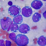 Burkitt_lymphoma
