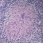 Granuloma