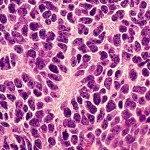 Medulloblastoma