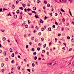 Oligodendroglioma