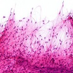 Pilocytic astrocytoma