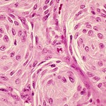 Meningioma