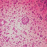Primary CNS lymphoma