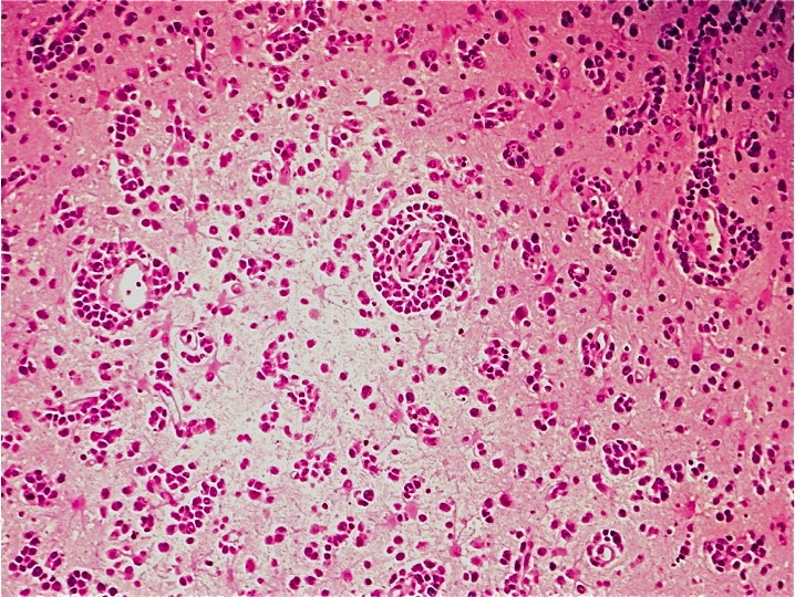 Primary CNS lymphoma Primary CNS lymphoma Primary CNS lymphoma: a tumor that preys on the immunosuppressed