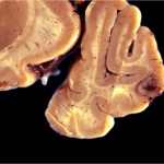 brain metastasis