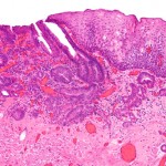 esophageal adenocarcinoma