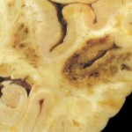 red infarct lower