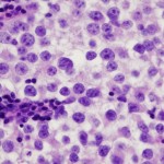 Seminoma