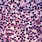 acute inflammation