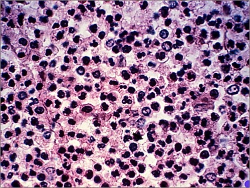 acute acute e1328501234340 How to differentiate acute vs. chronic inflammation in sections