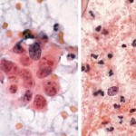 tumor diathesis