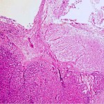 Pituitary