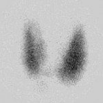 thyroid