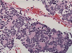 Homer Wright rosette HWrosette 300x222 The four main types of rosettes in pathology