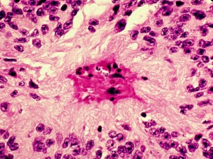 Vascular pseudorosette1 300x225 The four main types of rosettes in pathology