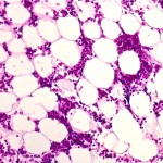 aplastic
