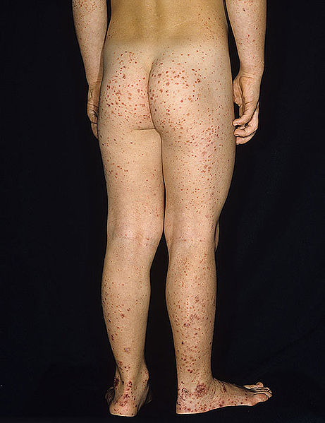 HSP HSP Henoch Schonlein purpura: the disease you never really learned about