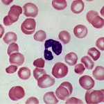 dysgranulopoiesis