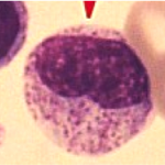 myelocyte myelocyte 150x150 Does differentiated mean it looks different?