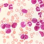CML blood smear