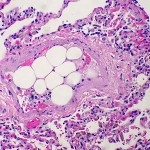 800px-Bone_marrow_embolus