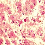 unknown liver case