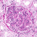Post-streptococcal glomerulonephritis