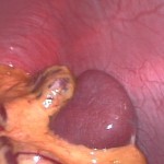 Spleen