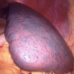 splenomegaly