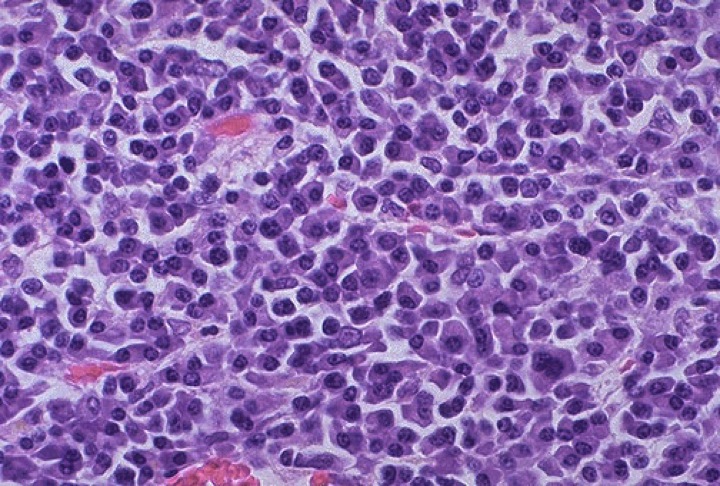 What does the blood look like in myeloma?