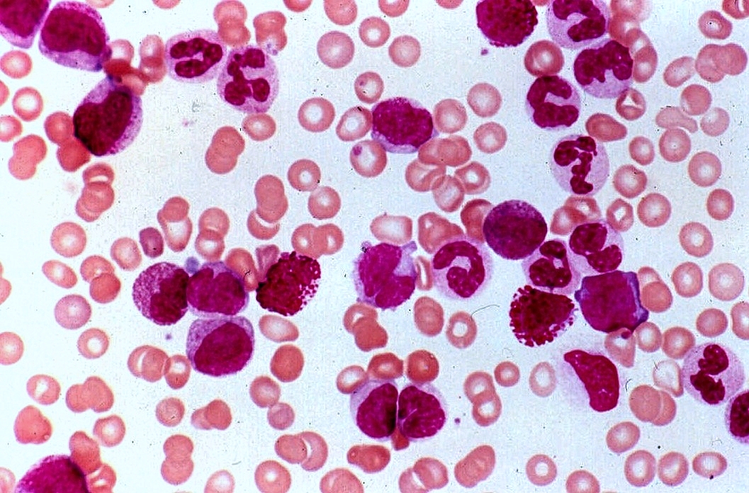 CML | Pathology Student
