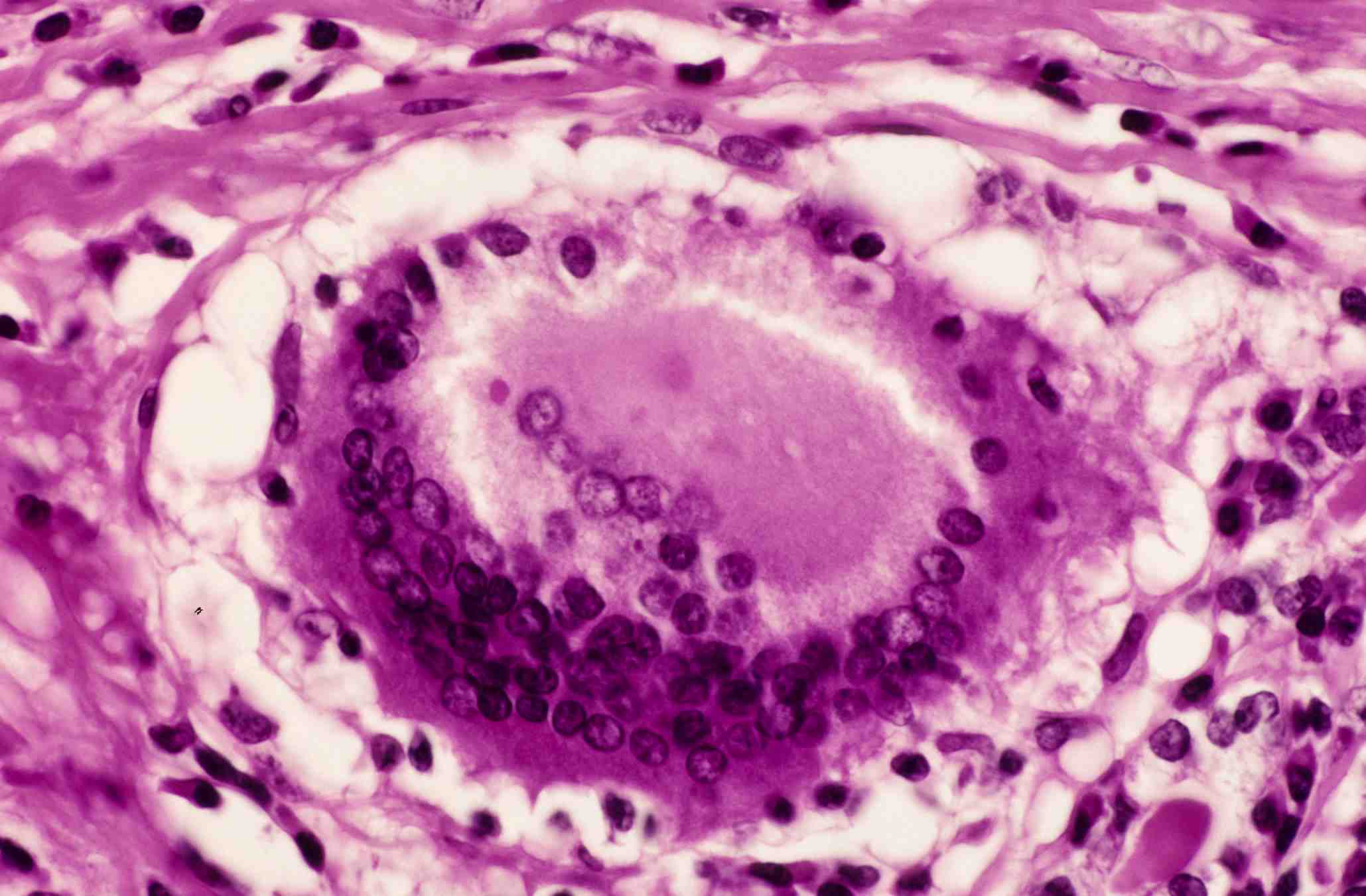 Subacute Granulomatous Thyroiditis Pathology Student