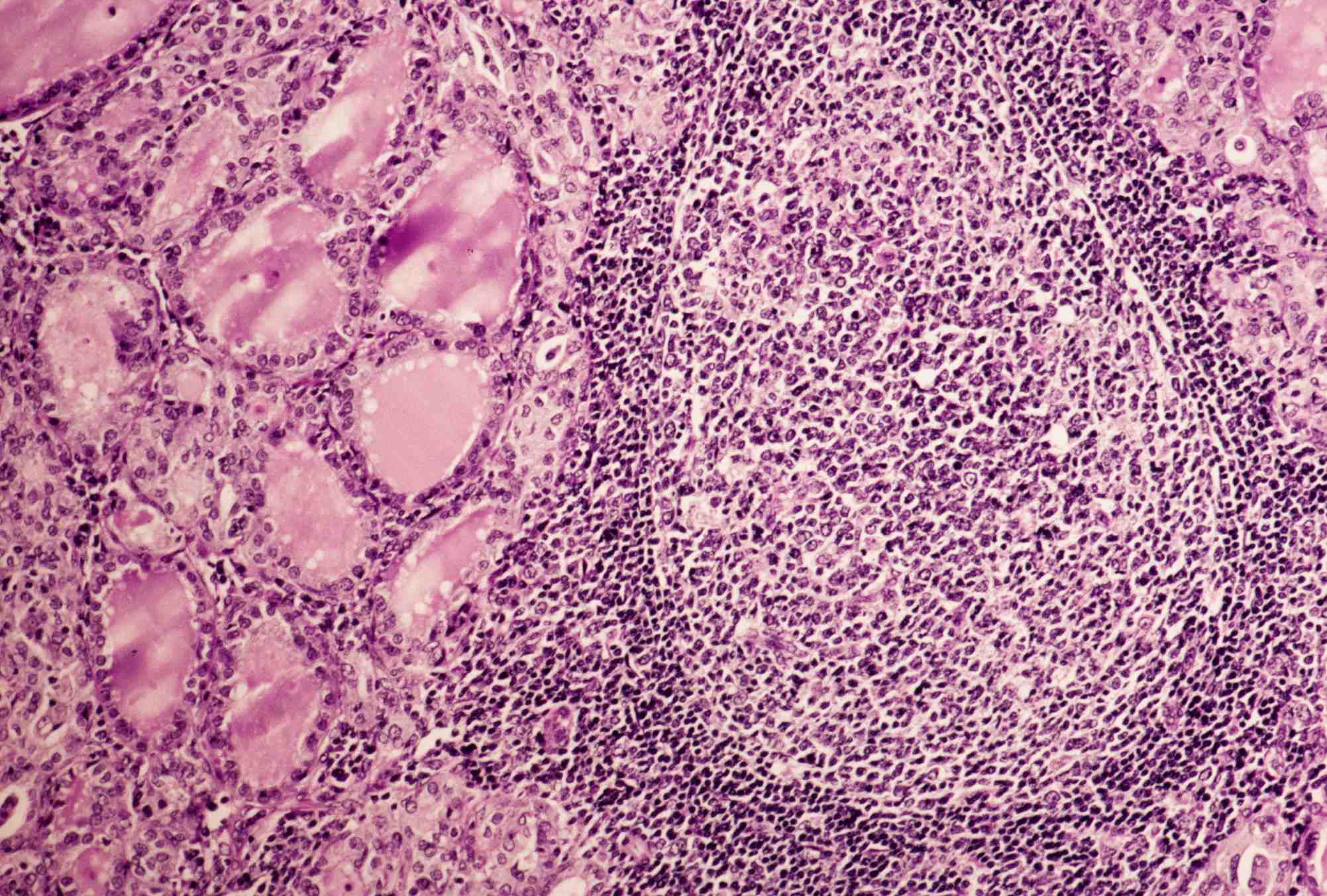 Hashimoto Thyroiditis Pathology Student